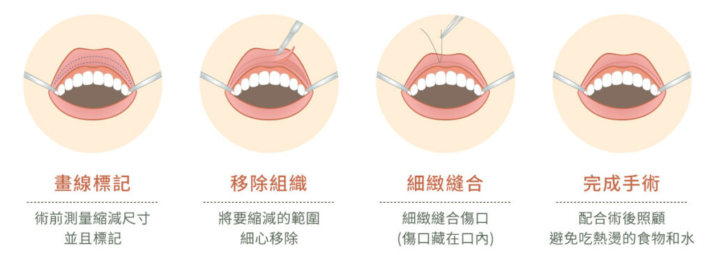 縮唇唇珠微笑嘴角 - 向昕美學