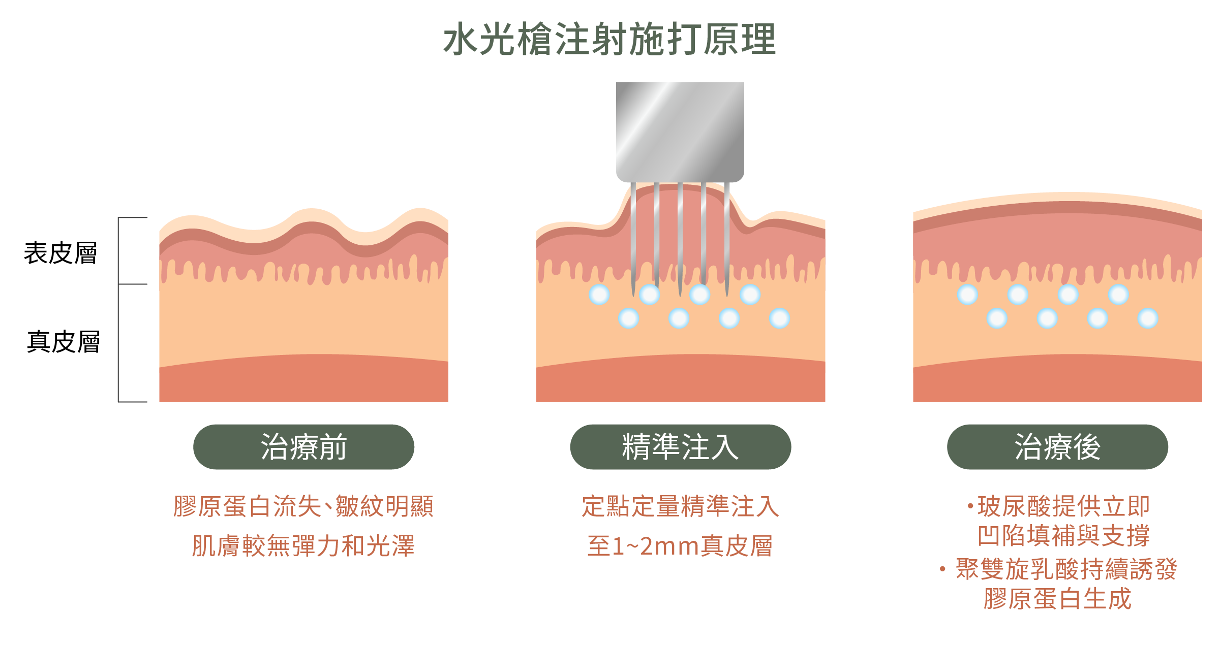 平面插畫，示意juvelook 水光槍作用原理