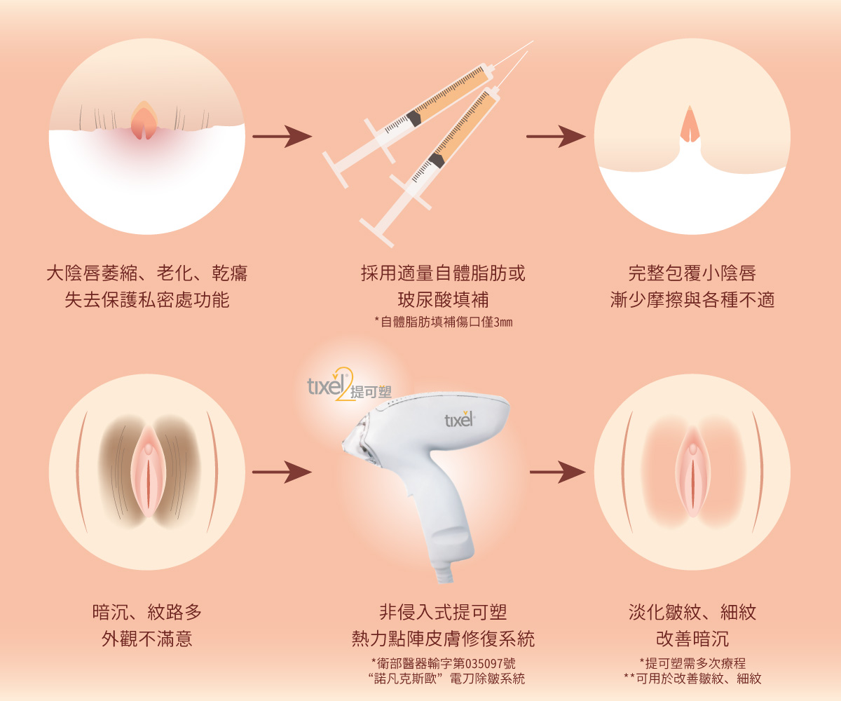 大陰唇豐潤,大陰唇補脂,提可塑,細紋,皺紋,暗沈,一線鮑,一字鮑