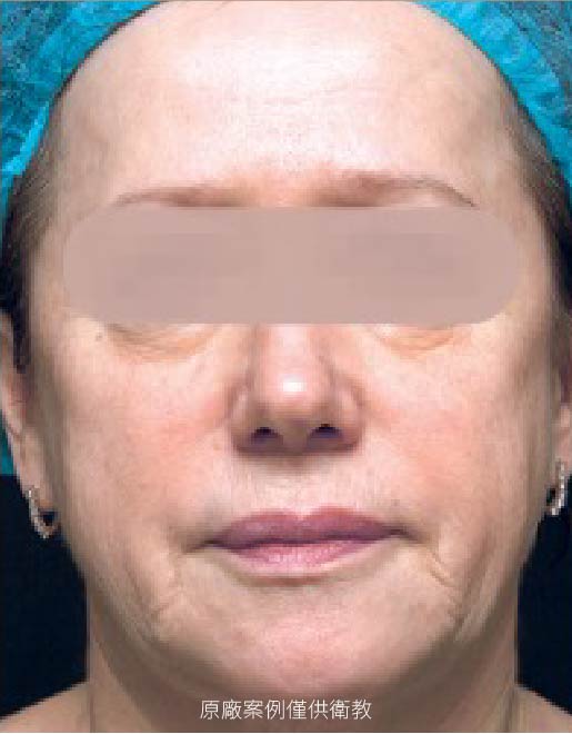 profhilobanner_profhilo case1