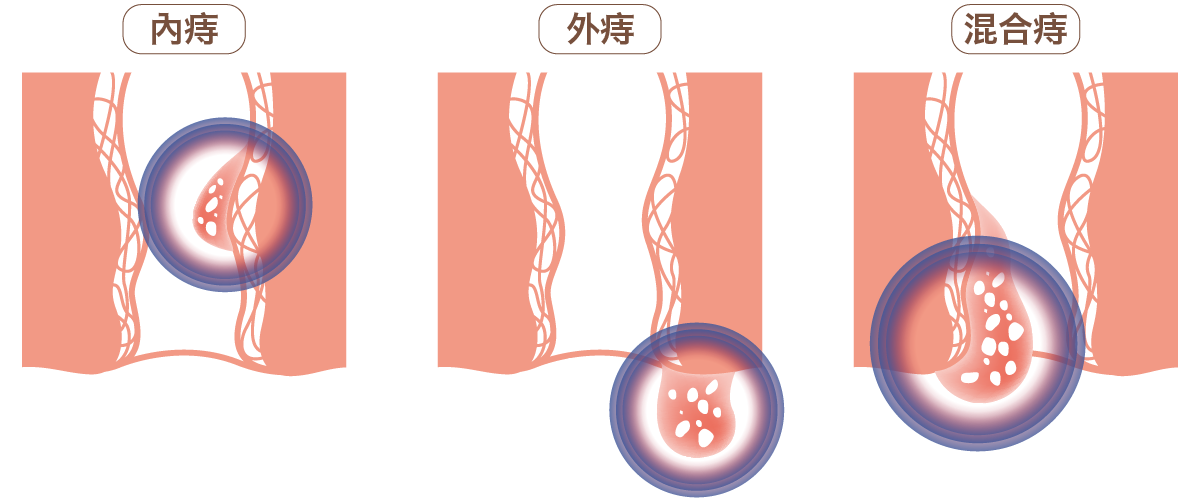 插圖顯示內痔、外痔、混合痔