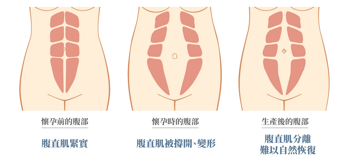 三階段的線條插畫，分別是懷孕前、懷孕中和生產後的腹直肌變化。