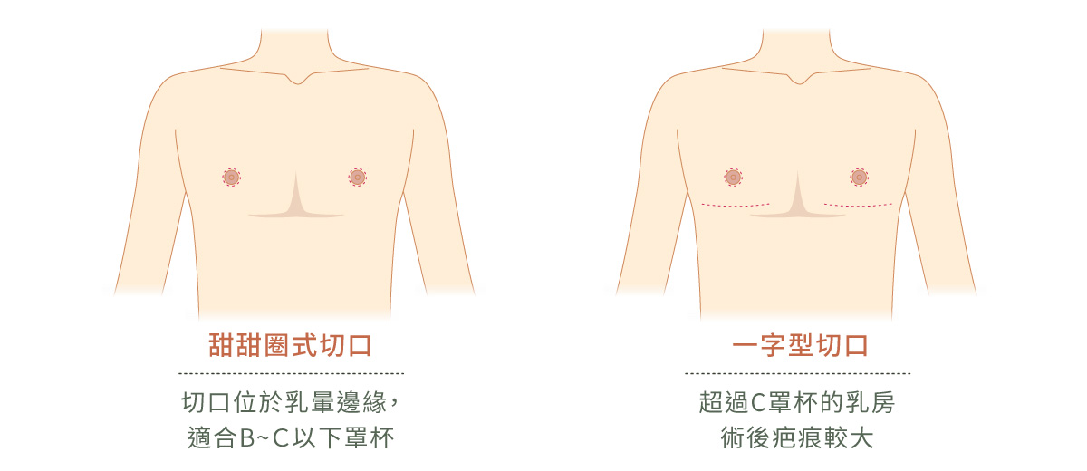 線條藝術畫，示意平胸手術的切口。