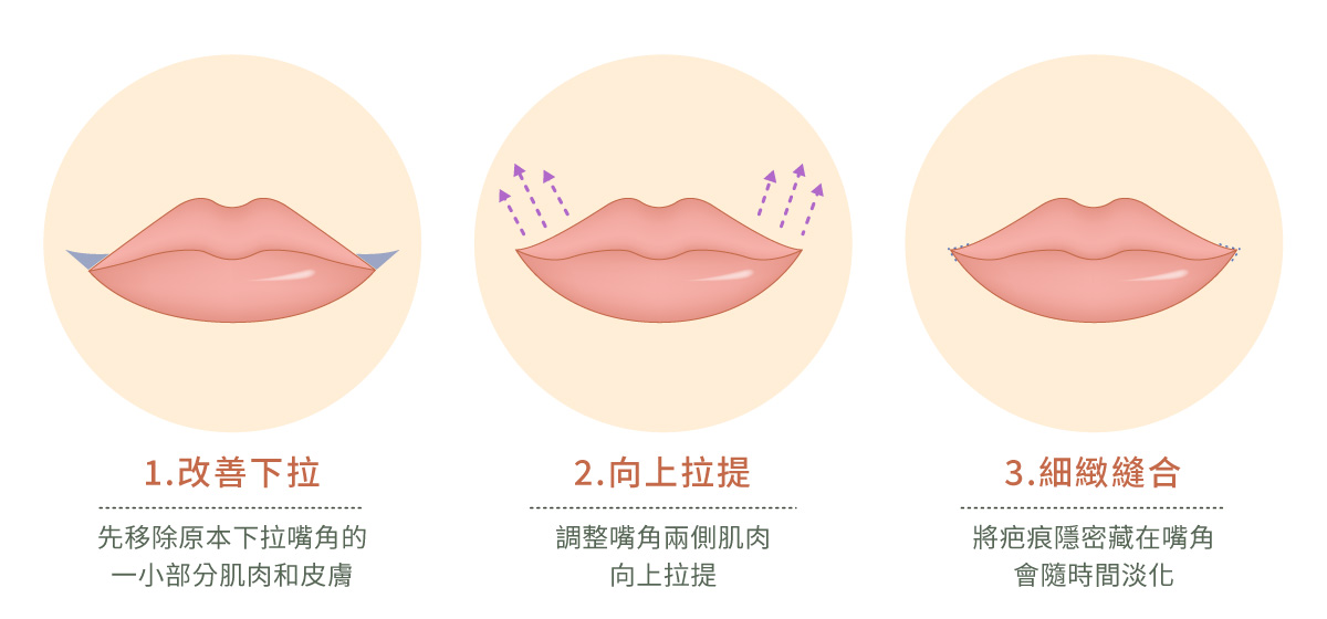 線條色塊插畫，展示微笑嘴角手術的階段性示意圖。