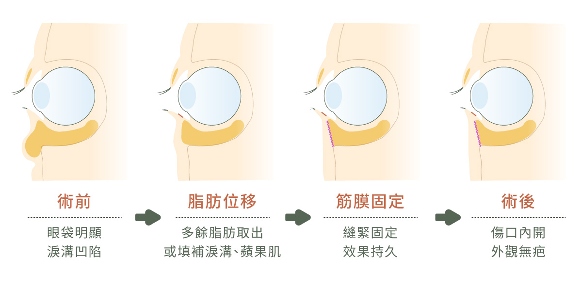 手術方式頗面圖，從術前到、脂肪轉位、縫緊筋膜到術後完成。