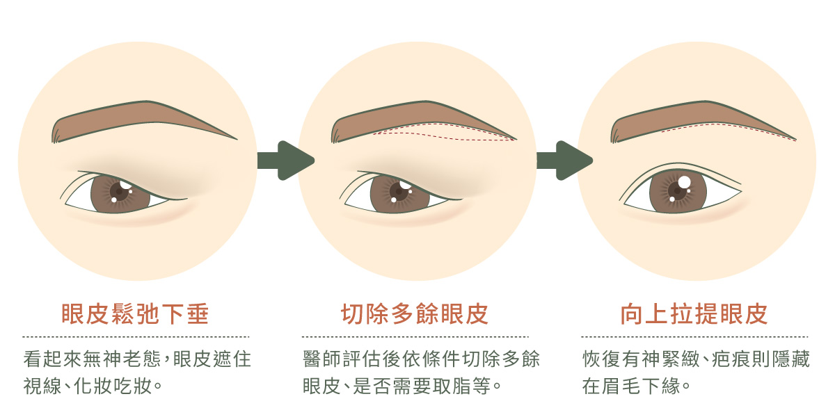 線條藝術畫，模擬眼皮下垂變成三角眼、遮擋視線，手術切除後恢復明亮眼神。