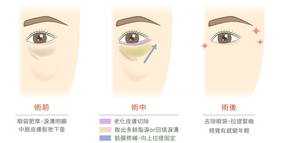 線條色塊插畫，示意眼袋外開和複合式中臉拉提的手術過程。