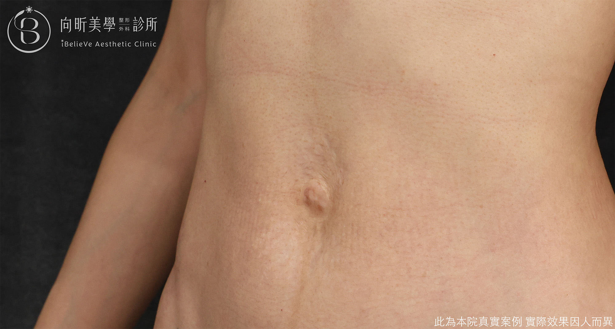 經肚臍內視鏡腹直肌修補case1-before.png