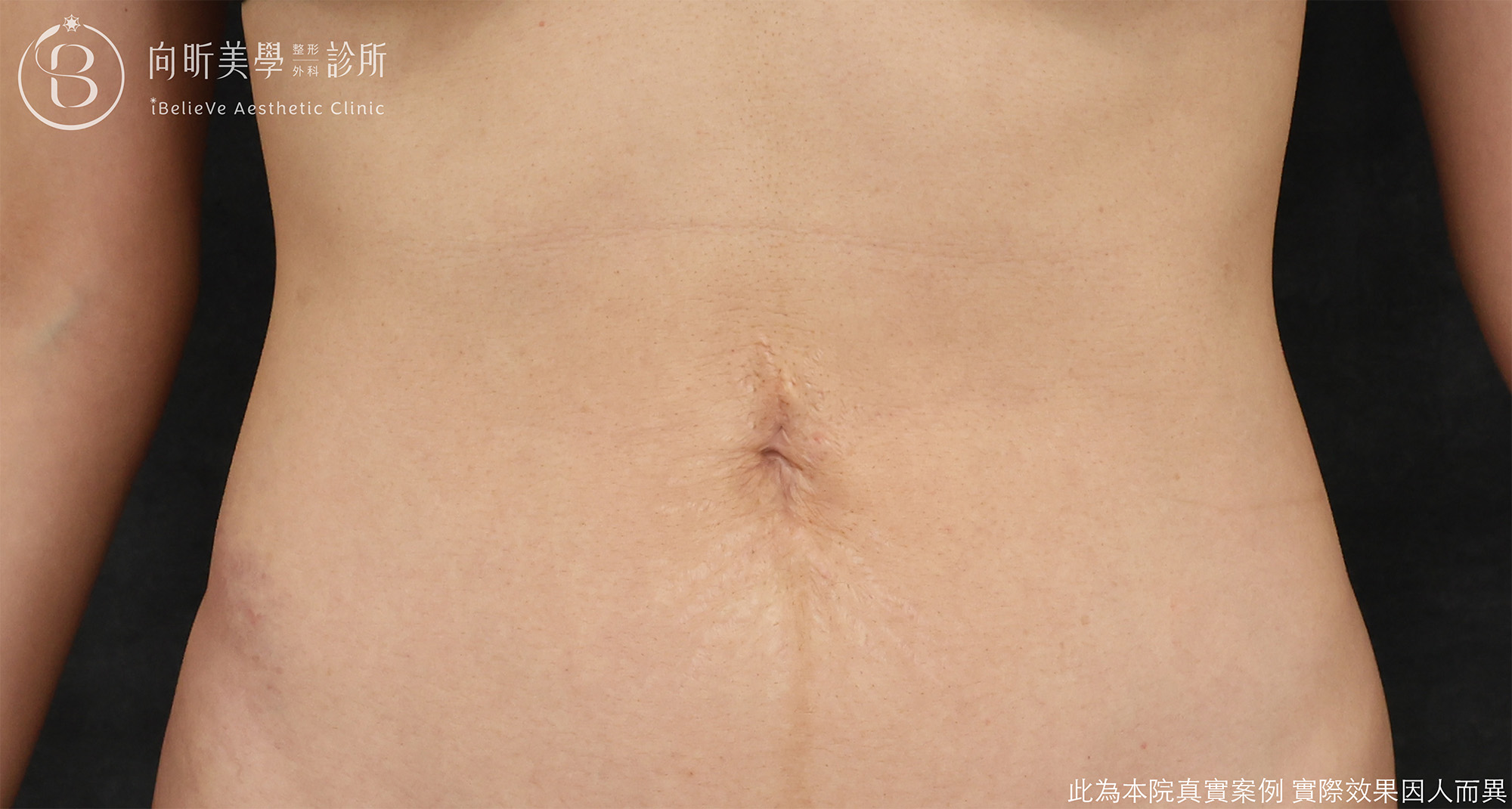 經肚臍內視鏡腹直肌修補case2-after.png