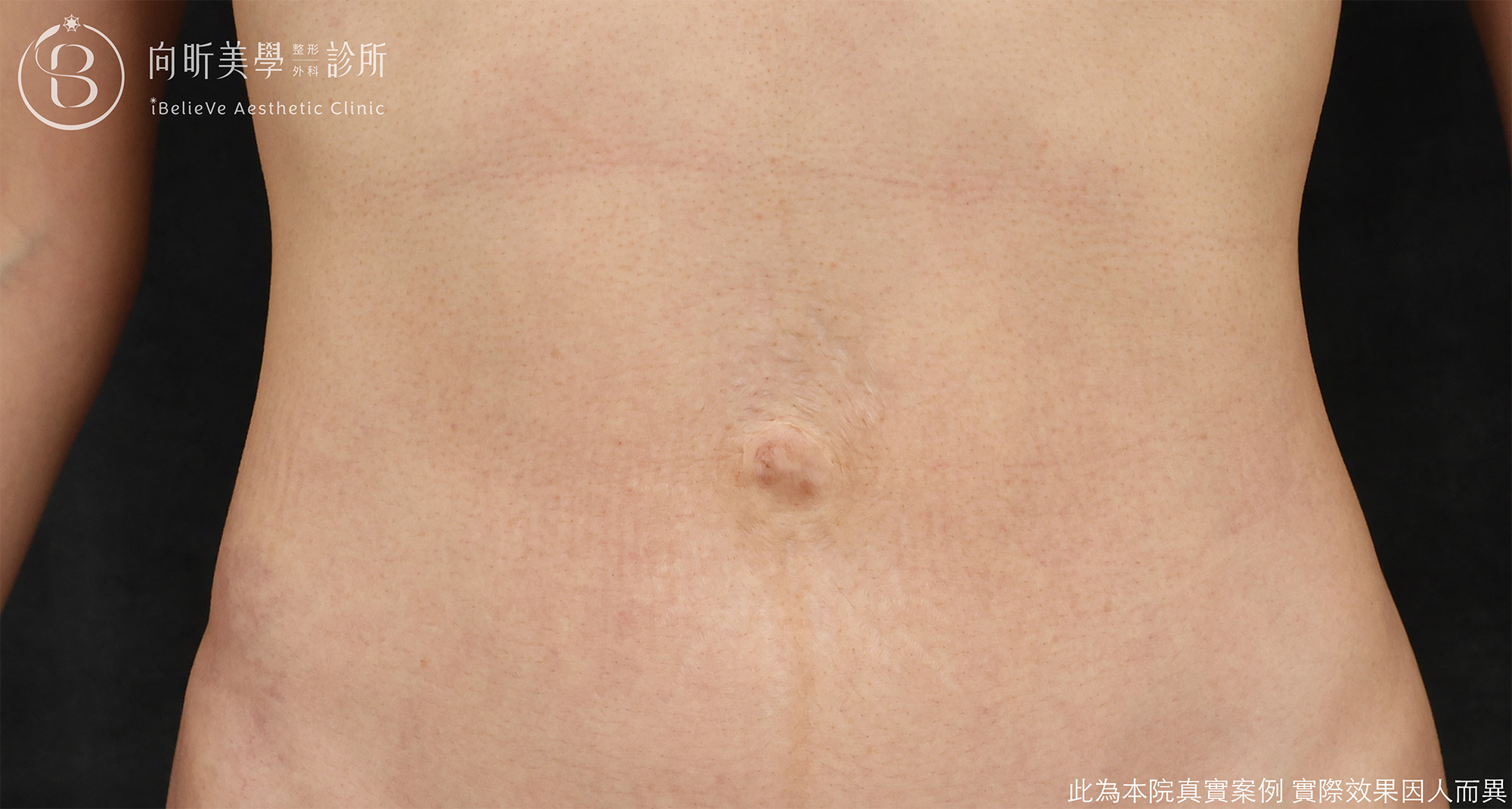 經肚臍內視鏡腹直肌修補case2-before.png