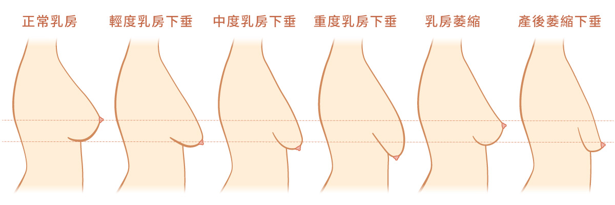 線條藝術畫，描繪乳房下垂的分級。