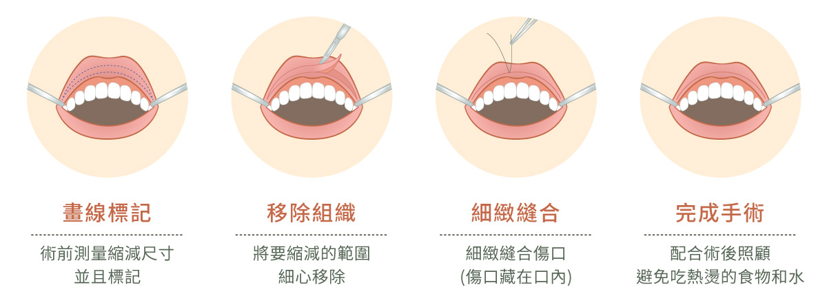 縮唇手術的線條示意插畫。