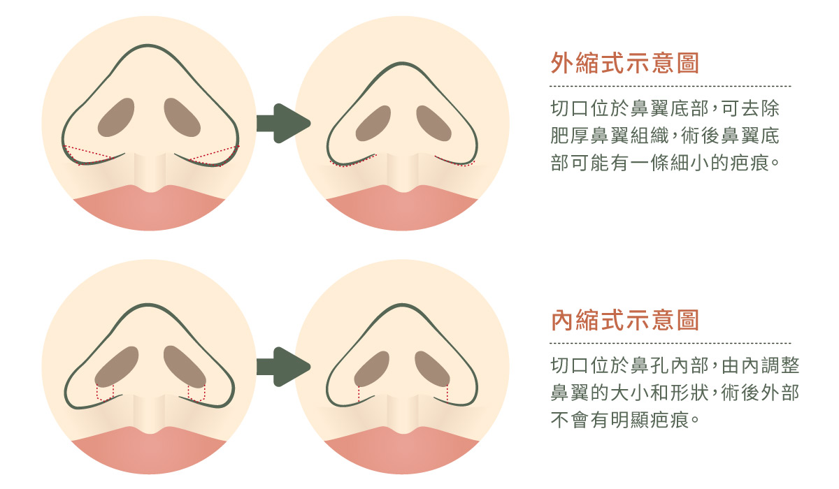 縮鼻翼兩種方式的模擬插畫。分為外縮和內縮，切口不同，都能達到縮小鼻翼的成效。